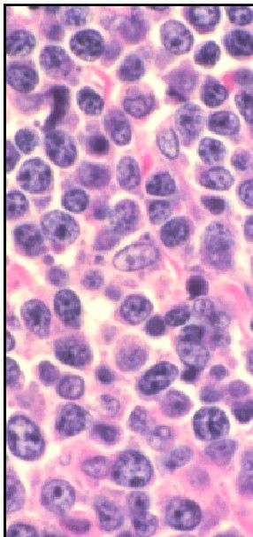 ပျံ့နှံ့လွယ်သည့် ဘီ-ဆဲလ်အကြီးစား ပြန်ရည်ကျိတ်ကင်ဆာ
