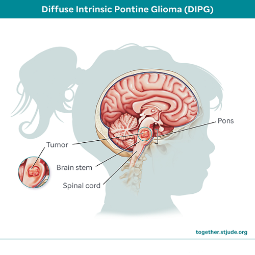 Diffuse intrinsic pontine glioma (DIPG) is an aggressive brain tumor. It begins in the brainstem in an area called the pons. The pons controls vital life functions as well as the nerves that control vision, hearing, speech, swallowing, and movement.