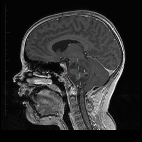 DIPG مریض کا MRI اسکین