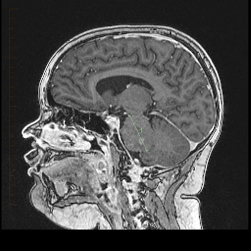 DIPG 患者的 MRI 扫描