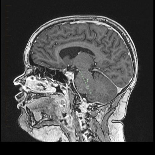 DIPG مریض کا MRI اسکین