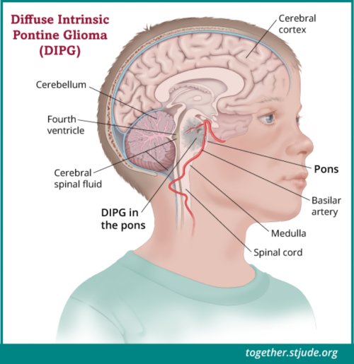 什么是 DIPG？扩散型内因性脑桥神经胶质瘤（DIPG）是一种侵袭性脑肿瘤，开始于脑干中称为脑桥的区域。脑桥负责重要的生命功能以及控制视力、听觉、言语、吞咽和运动的神经。