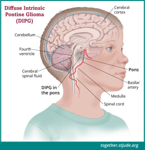 DIPG کیا ہے؟ ڈفیوز انٹرینسک پونٹائن گلیوما DIPG ایک ناگوار برین ٹیومر ہے جو دماغ کے حصے میں پونس کہلاتا ہے۔ پونس زندگی کے اہم کاموں کے ساتھ ساتھ اعصاب کے لیے بھی ذمہ دار ہے جو بینائی، سماعت، بولنے، نگلنے اور نقل و حرکت پر قابو رکھتا ہے۔