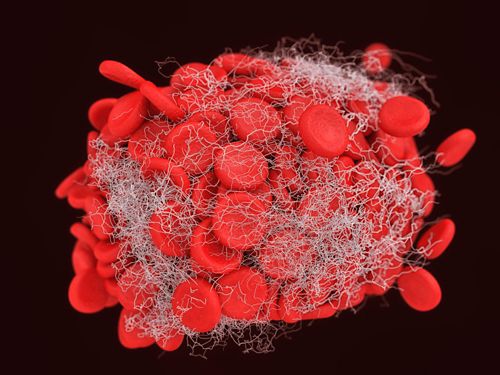 Blood clot showing hair-like fibrinogen clumping the red blood cells together. 