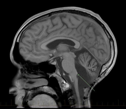 Many ependymomas form in the fourth ventricle in the posterior fossa region. Tumors in this location are most likely to affect the brain stem and cerebellum. 