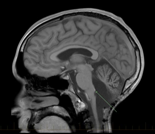 يتشكل عدد من أورام البطانة العصبية في البُطين الرابع في منطقة الحفرة الخلفية. تؤثر الأورام في هذه المنطقة على جذع الدماغ والمخيخ في أغلب الأحوال.