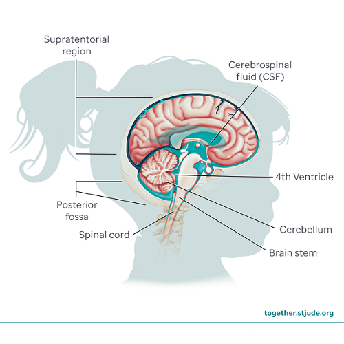 Ependymoma brain anatomy