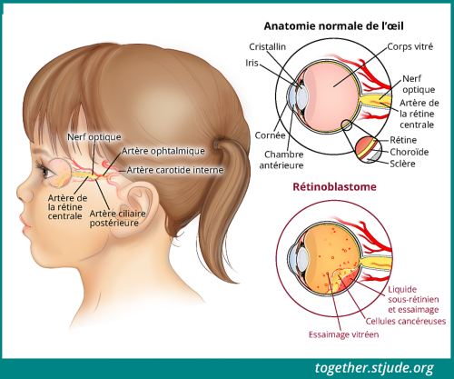 Retinoblastome Chez Les Enfants Et Les Adolescents Ensemble