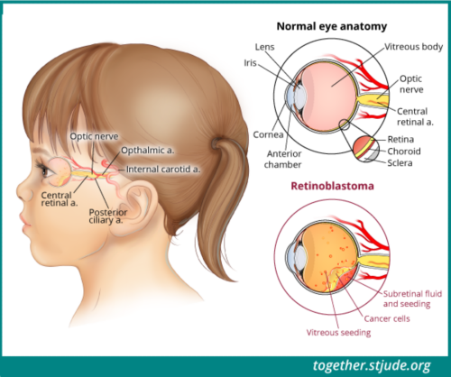 What is retinoblastoma? Retinoblastoma is a cancer that forms in the retina of the eye. The retina is a thin layer of nerve tissue in the back of the eye.