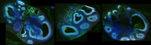 Cerebral organoids, models used for research, made of neural progenitor cells with mutated CDK6 