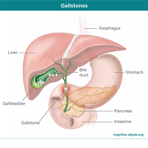 How gallstones can affect the gallbladder