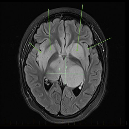 MRI scan showing gliomatosis cerebri pattern of growth crossing hemispheres of the brain.