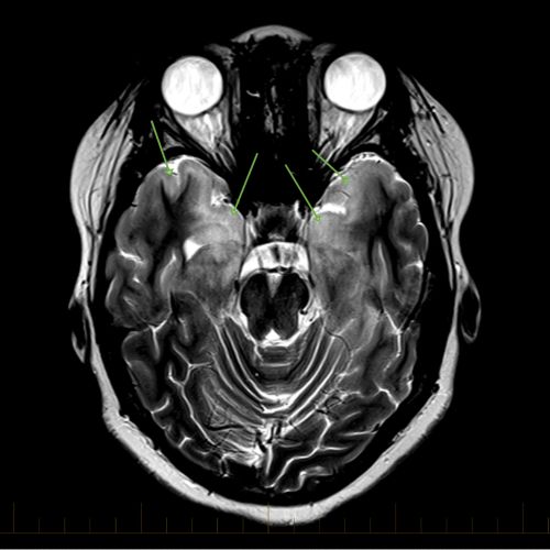 轴位 MRI 及指示大脑胶质瘤病的标记