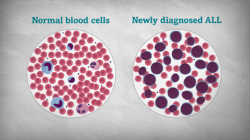 Illustration of two histology slides side by side highlights the difference between normal bloody cells and blood cells in newly diagnosed ALL.