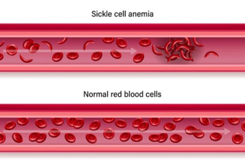 Acute pain in sickle cell disease can be related to clumping of sickle cells in veins and arteries