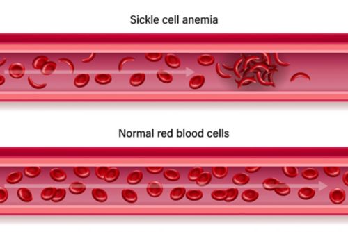 El dolor agudo en la enfermedad de células falciformes puede estar relacionado con la acumulación de células falciformes en venas y arterias