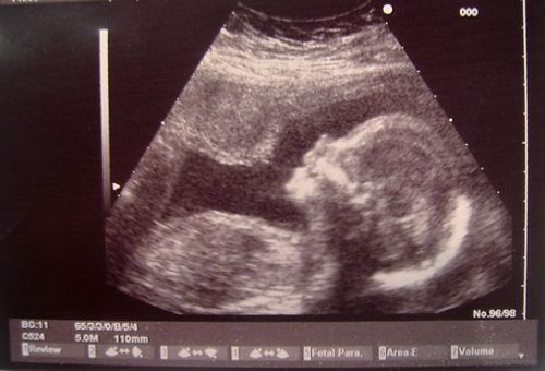 Image of fetus