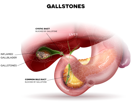 De qué manera los cálculos biliares pueden afectar la vesícula biliar