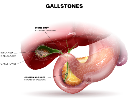 How gallstones can affect the gallbladder