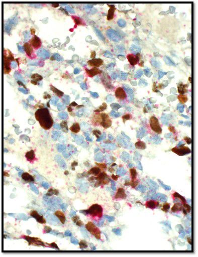 La muestra de inmunohistoquímica muestra blastos que tienen marcadores de células T en rojo y marcadores de megacariocitos en marrón.
