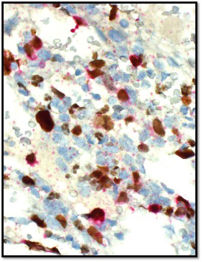 Muestra de inmunohistoquímica que muestra blastos que tienen marcadores de células T en rojo y marcadores de megacariocitos en marrón.