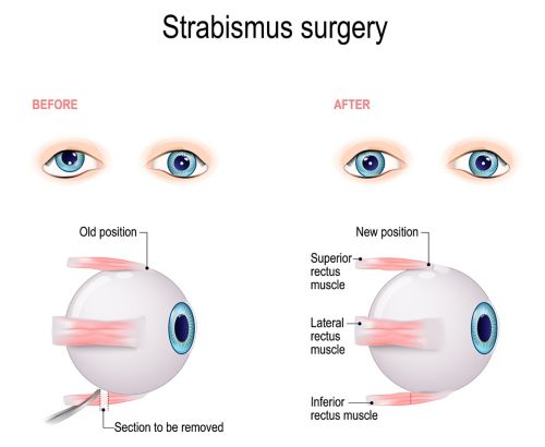 Illustration demonstrating how surgery adjusts the position of the eye so both eyes look in the same direction