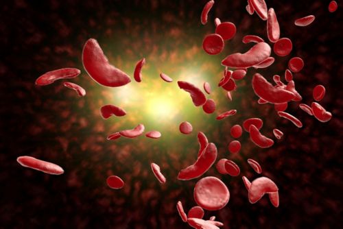 Glóbulos rojos falciformes 