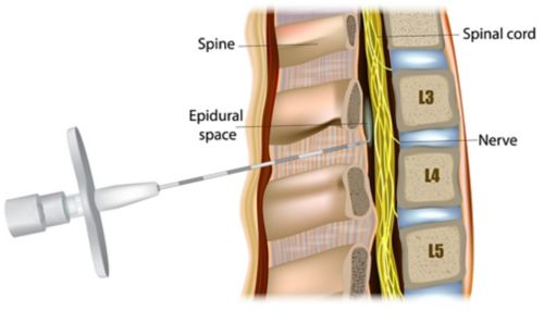 Administración epidural o anestesia epidural. El medicamento se inyecta en el espacio epidural alrededor de la médula espinal.