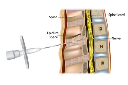 Administración epidural o anestesia epidural. El medicamento se inyecta en el espacio epidural alrededor de la médula espinal.