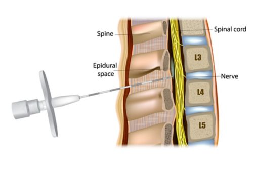 Administration épidurale ou anesthésie épidurale. Le médicament est injecté dans l'espace épidural autour de la moelle épinière.
