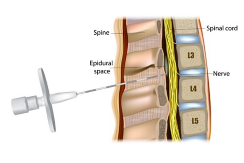 Administração peridural ou anestesia peridural. O medicamento é injetado no espaço peridural ao redor da medula espinhal.