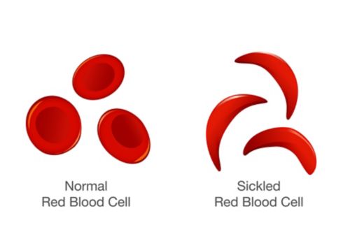 Glóbulos rojos normales y glóbulos rojos falciformes