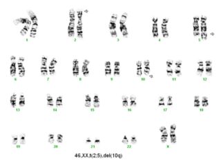 Female (XX) karyotype with abnormal chromosome arrangement at 2, 5, and 10