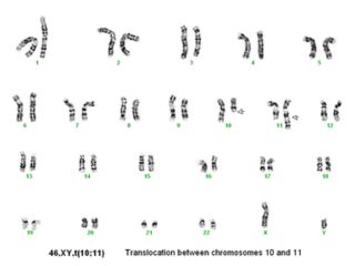 ခရိုမိုဆုမ်း ၁၀ နှင့် ၁၁ အကြား DNA တွင်းပါဝင်ပစ္စည်း လွှဲပြောင်းမှုကို ပြသည့် ယောကျ်ားလေး ကလေး ကင်ဆာလူနာ၏ ကာရိုတိုက်ပ် (Karyotype)