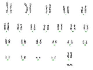 Caryotype féminin (XX) avec disposition chromosomique normale