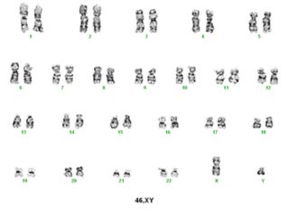 Imagen de un cariotipo masculino; incluye la cantidad y apariencia de los cromosomas del núcleo de una célula.