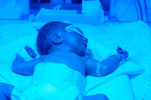 bebé bajo la luz de la terapia de luz