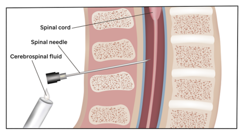显示脊柱针头插入脊柱中以采集脑脊液样本的图