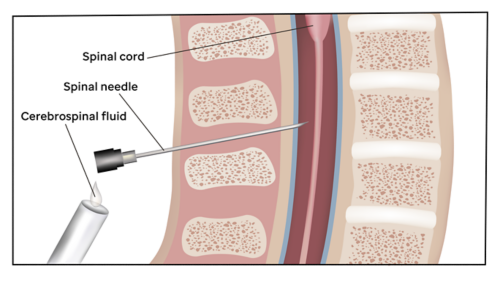 Illustration montrant une aiguille à ponction lombaire insérée dans la colonne vertébrale pour prélever l'échantillon de liquide céphalorachidien.