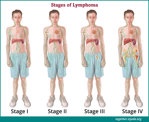Esta ilustração mostra as áreas do corpo afetadas pela doença em cada estágio do linfoma não Hodgkin.