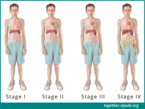 Cette illustration montre les zones du corps affectées par la maladie à chaque stade du lymphome non hodgkinien.