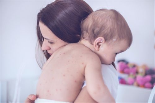 Una madre sosteniendo a su bebé con una erupción de sarampión