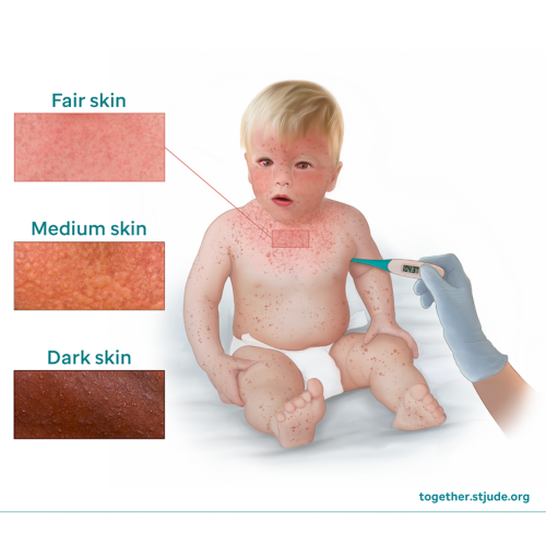 Illustration of a baby with measles getting temperature taken