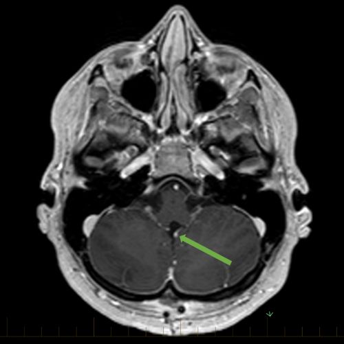 МРТ в осевой проекции; стрелка указывает на медуллобластому