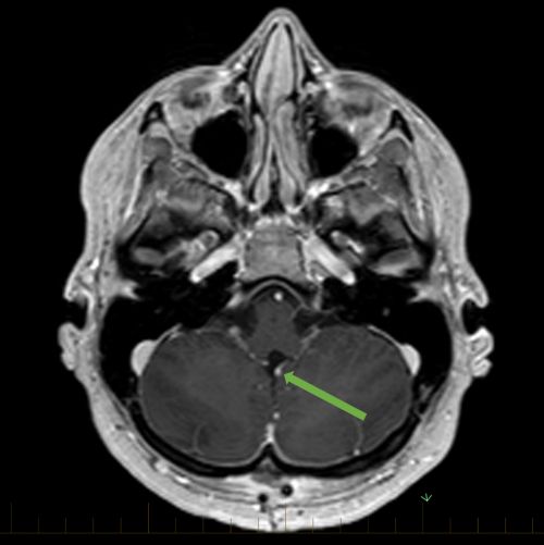 横切面 MRI，箭头指向髓母细胞瘤