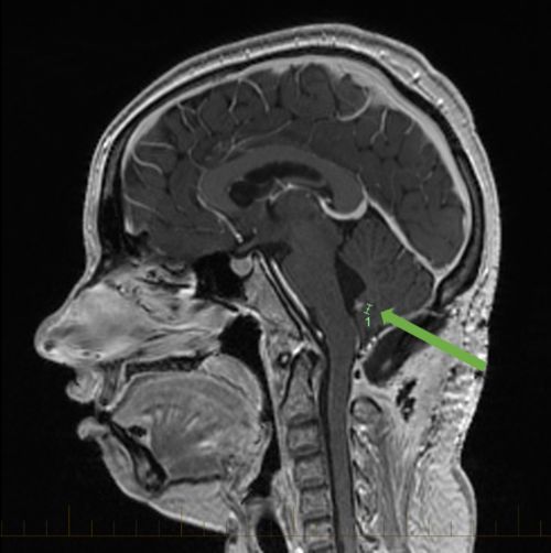 La exploración por IRM con marcas que muestran meduloblastoma en el cerebelo.