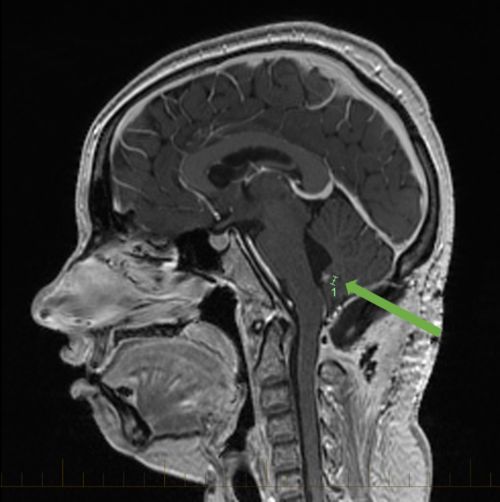 MRI scan with markings showing medulloblastoma in the cerebellum.