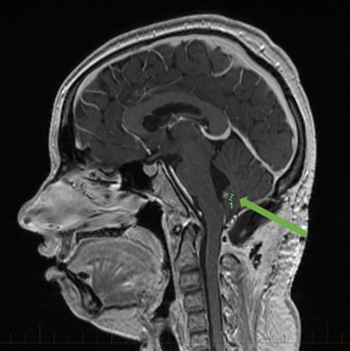 IRM sagital con una flecha que apunta hacia el meduloblastoma