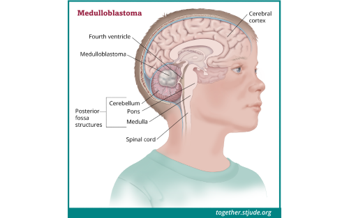 Medical illustration of medulloblastoma