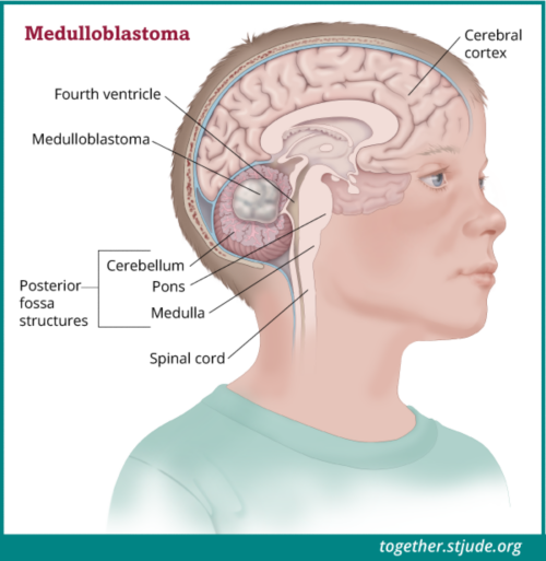 Los tumores en la región de la fosa posterior constituyen más de la mitad de todos los tumores cerebrales en niños. Aproximadamente el 25 % de los niños que se someten a una cirugía para extirpar un meduloblastoma, un tumor de la fosa posterior, presentarán el síndrome de la fosa posterior. 